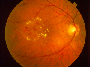 Chicago Eye Doctor